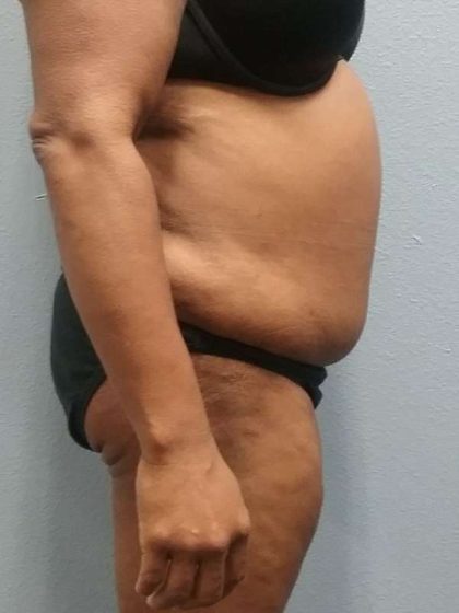 Brazilian Butt Lift Before & After Patient #4807
