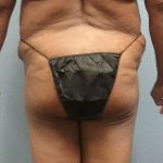 Brazilian Butt Lift Before & After Patient #4807