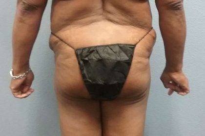 Brazilian Butt Lift Before & After Patient #4807