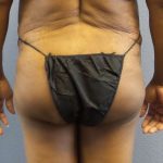 Brazilian Butt Lift Before & After Patient #4807