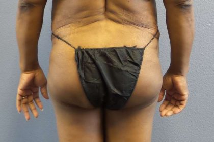 Brazilian Butt Lift Before & After Patient #4807