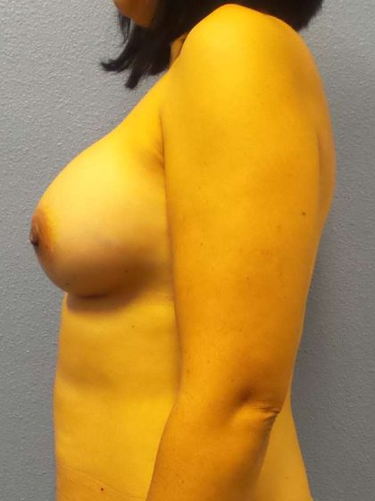 Breast Augmentation Before & After Patient #5764