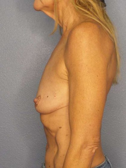 Breast Augmentation Before & After Patient #7056
