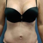 Abdominoplasty Revision Before & After Patient #3888