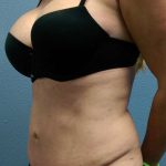 Abdominoplasty Revision Before & After Patient #3888