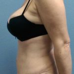 Abdominoplasty Revision Before & After Patient #3888