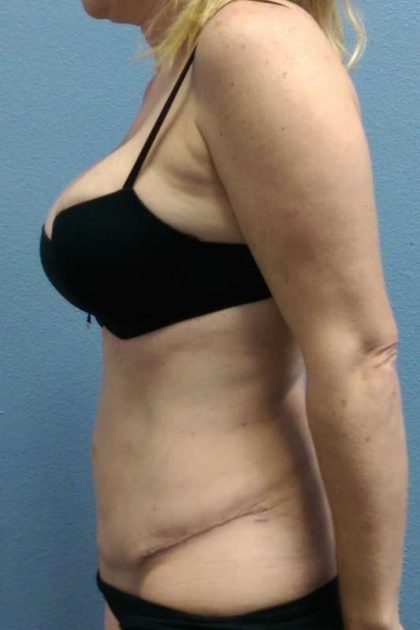 Abdominoplasty Revision Before & After Patient #3888