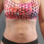Abdominoplasty Revision Before & After Patient #3888