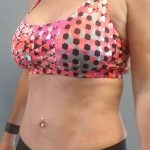 Abdominoplasty Revision Before & After Patient #3888