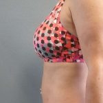 Abdominoplasty Revision Before & After Patient #3888