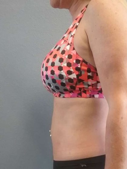 Abdominoplasty Revision Before & After Patient #3888