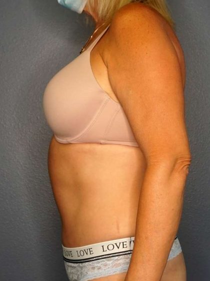 Abdominoplasty Before & After Patient #3448