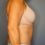 Abdominoplasty Before & After Patient #3448