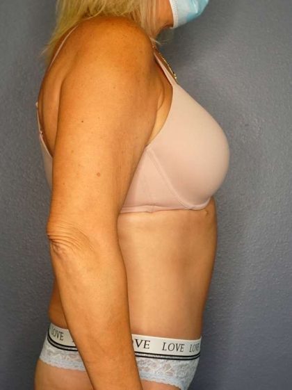 Abdominoplasty Before & After Patient #3448