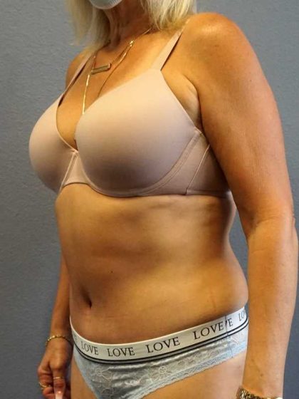 Abdominoplasty Before & After Patient #3448