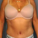 Abdominoplasty Before & After Patient #3448