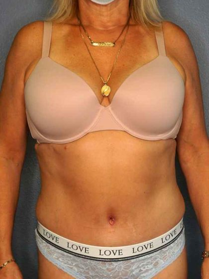 Abdominoplasty Before & After Patient #3448