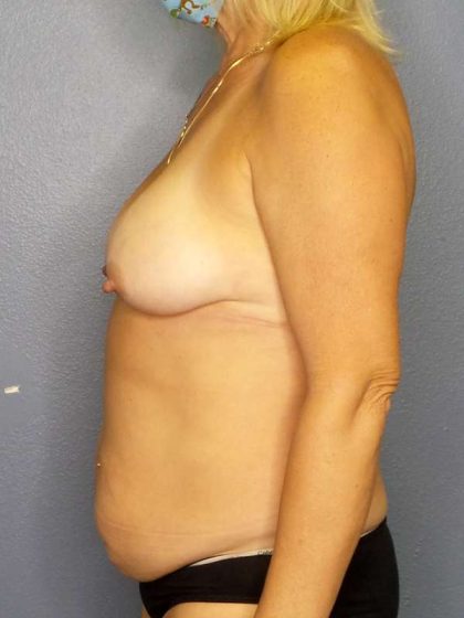 Abdominoplasty Before & After Patient #3448