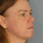 Resurfacing Before & After Patient #9717