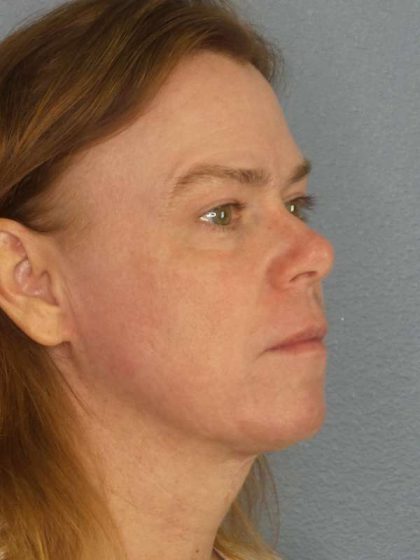 Resurfacing Before & After Patient #9717