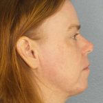 Resurfacing Before & After Patient #9717