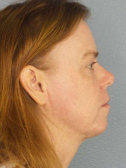Resurfacing Before & After Patient #9717