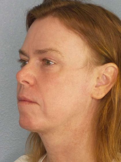 Resurfacing Before & After Patient #9717