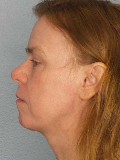 Resurfacing Before & After Patient #9717
