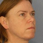 Resurfacing Before & After Patient #9717