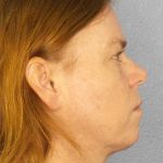 Resurfacing Before & After Patient #9717