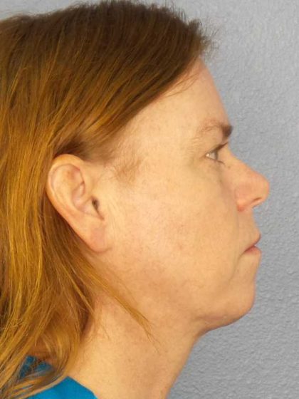 Resurfacing Before & After Patient #9717