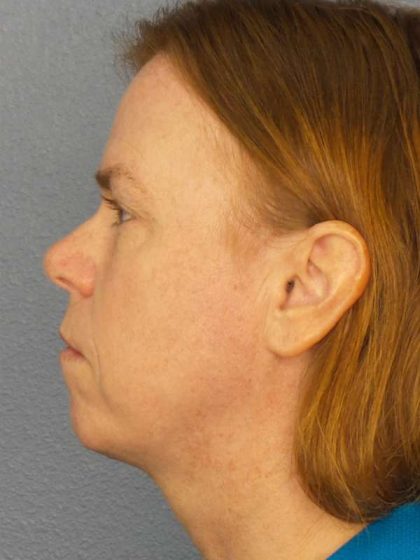 Resurfacing Before & After Patient #9717