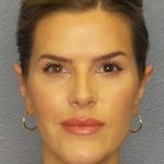 Otoplasty Before & After Patient #8516