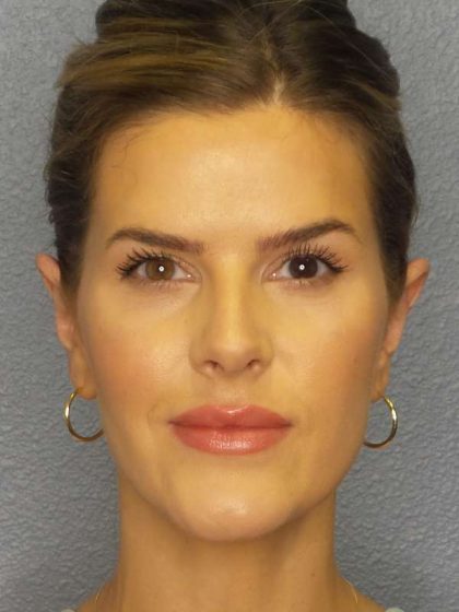 Otoplasty Before & After Patient #8516