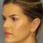 Otoplasty Before & After Patient #8516
