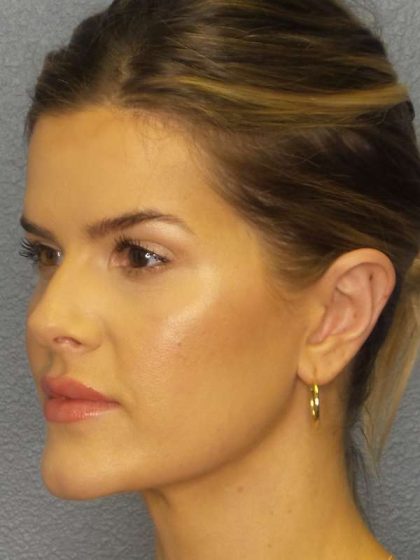 Otoplasty Before & After Patient #8516