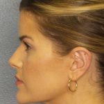 Otoplasty Before & After Patient #8516