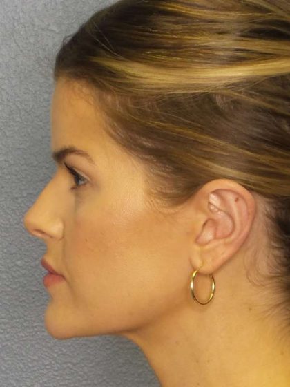 Otoplasty Before & After Patient #8516