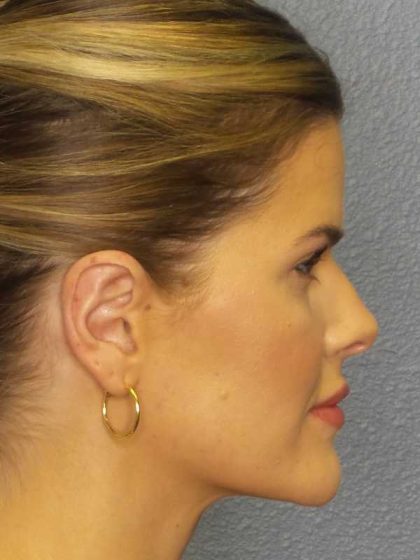 Otoplasty Before & After Patient #8516