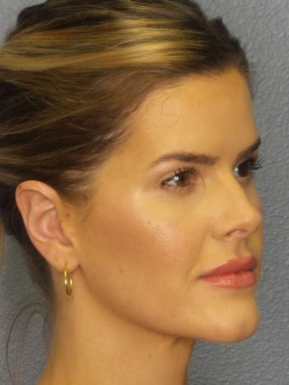 Otoplasty Before & After Patient #8516