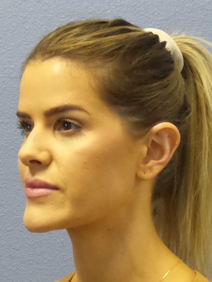 Otoplasty Before & After Patient #8516