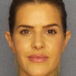 Otoplasty Before & After Patient #8516
