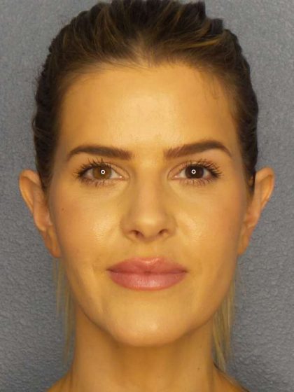 Otoplasty Before & After Patient #8516