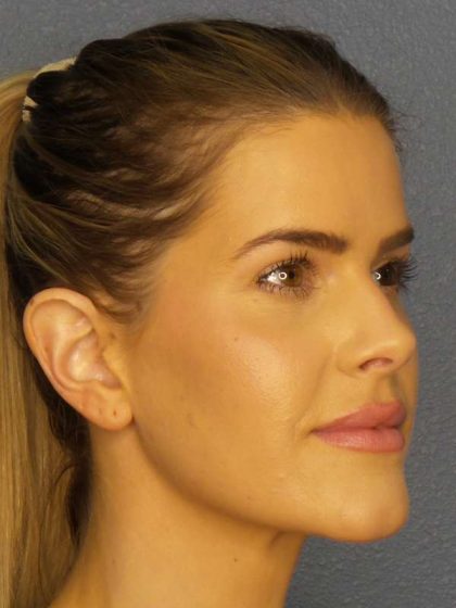 Otoplasty Before & After Patient #8516