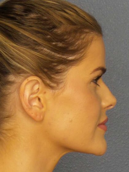Otoplasty Before & After Patient #8516