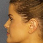 Otoplasty Before & After Patient #8516