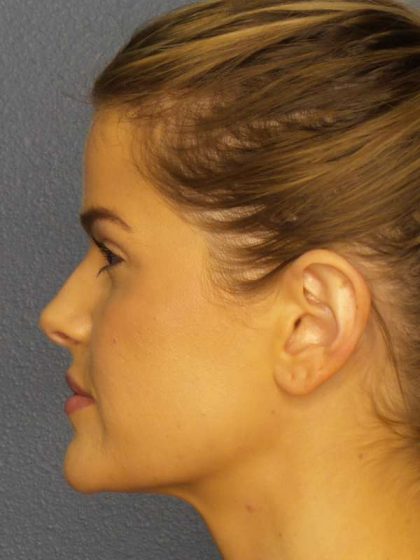 Otoplasty Before & After Patient #8516