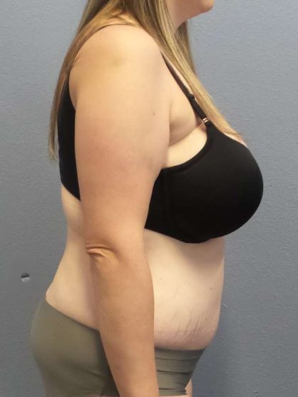 Abdominoplasty Before & After Patient #3881