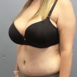 High BMI (Larger Patients) Surgery Before & After Patient #10482