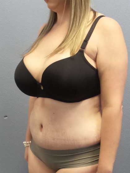 Abdominoplasty Before & After Patient #3881